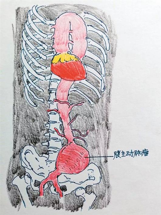 南京医科大学第二附属医院心血管中心副主任医师邵峻绘出腹主动脉瘤，向患者解释此手术危险性。