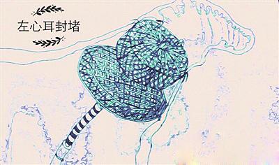 江苏省人民医院老年心血管科褚明绘图讲述左心耳封堵术
