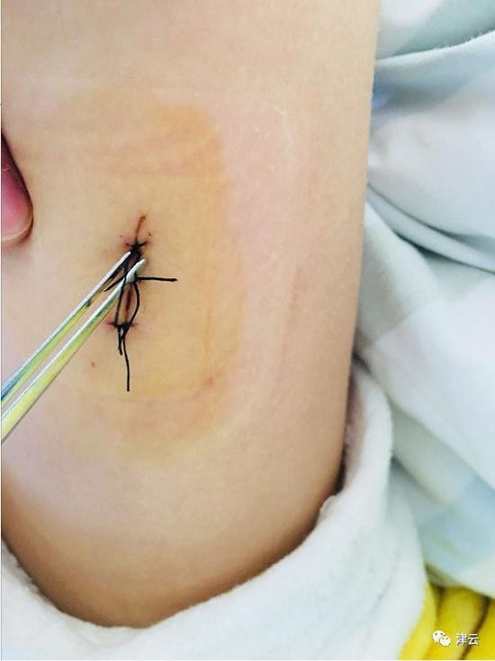 事发后，琪琪母亲拍摄的伤口