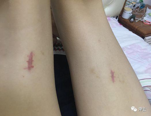 目前的现状，伤口处留下伤疤
