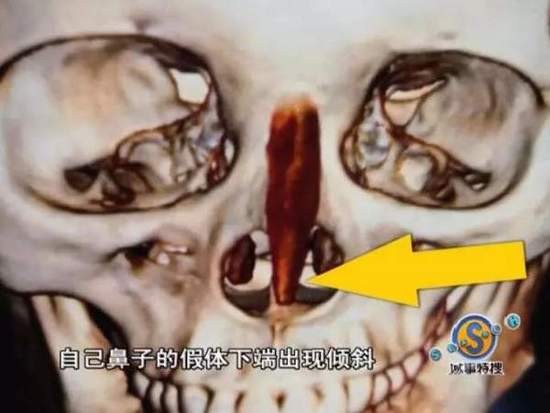 女子花9万整容结果鼻子下巴歪了 院方:你去跳楼啊