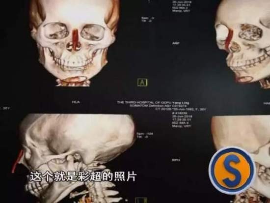 女子花9万整容结果鼻子下巴歪了 院方:你去跳楼啊