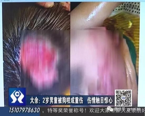 近日,大余县青龙镇长里村一位2岁多的男孩成成,遭到村里一只狗的疯狂撕咬,导致头部面颊被咬开多个口子,狗主人竟然不承认。