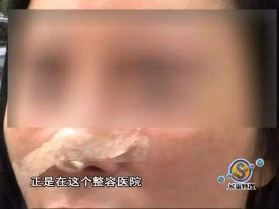 女子花9万整容结果鼻子下巴歪了 院方:你去跳楼啊