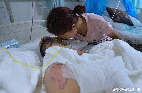 萧萧腰部也被严重烫伤。