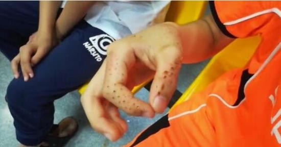 好痛！仙人掌从15楼砸下 男孩耳朵成“马蜂窝”