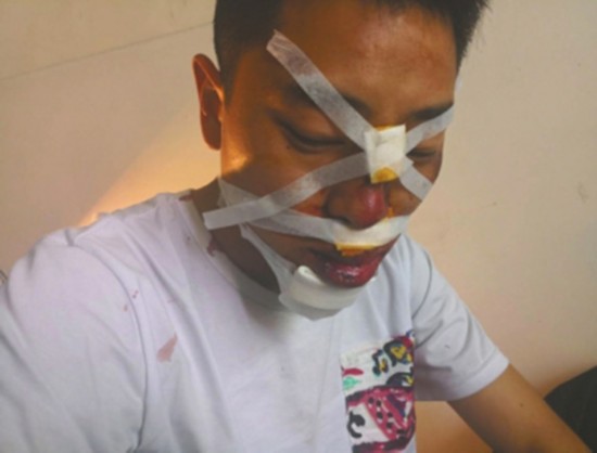 警察请缨上救灾一线跌落山沟 面部缝28针伤势严重