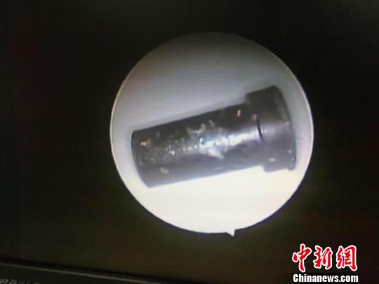 广州男孩把玩具塞进耳朵专家:若异物入耳勿自行掏取