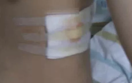 这体型小心!小伙伸懒腰肺竟炸了 引出1500毫升血