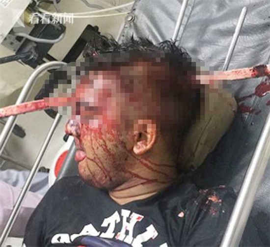 神奇!男子遇车祸被1米铁棍贯穿头部 结果大难不死