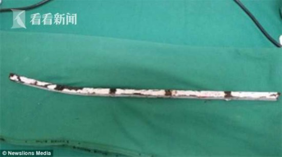 神奇!男子遇车祸被1米铁棍贯穿头部 结果大难不死