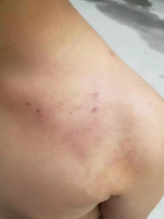 被打孩子浑身是伤，并且多处淤青。