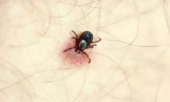  蜱虫 视觉中国 资料图