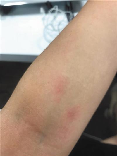 姚某称在居住期间皮肤出现过敏红肿。受访者供图