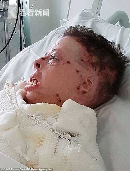 女子救助生病邻居 反遭对方丈夫泼汽油点燃致毁容