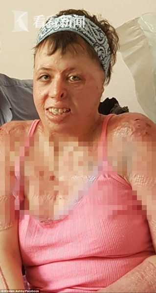 女子救助生病邻居 反遭对方丈夫泼汽油点燃致毁容