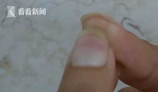 男子杀鱼时不小心划伤手指 几个月后右手被蛀空