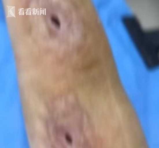 男子杀鱼时不小心划伤手指 几个月后右手被蛀空