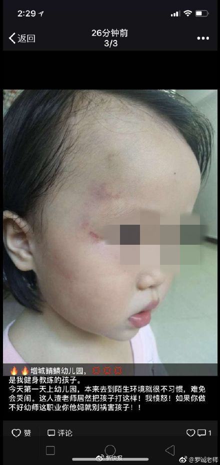 孩子刚入读幼儿园就被打? 疑因老师失恋被扇耳光