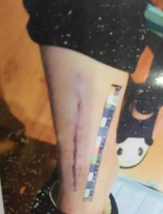 △受害女生腿上留下的伤痕