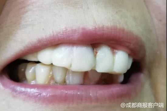 婆婆只想测个血压 却被忽悠花3千安了一口塑料牙