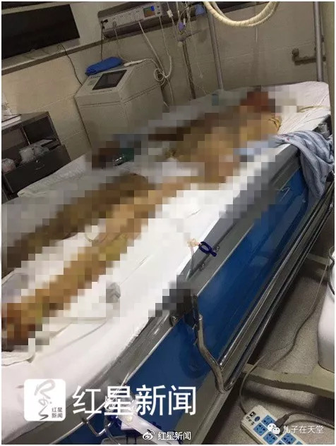 美达股份员工烫伤身亡 生前担心不能工作连累家人