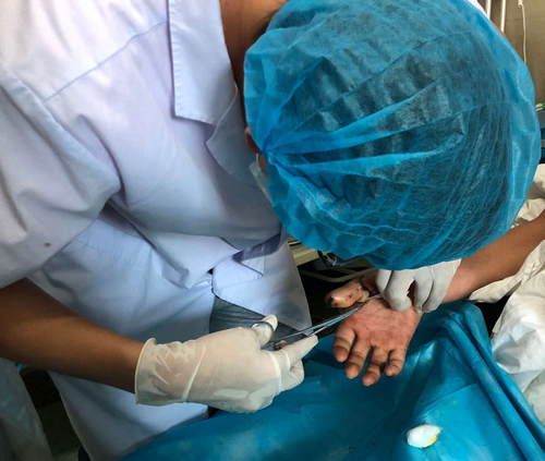 手术成功之后正在拆线