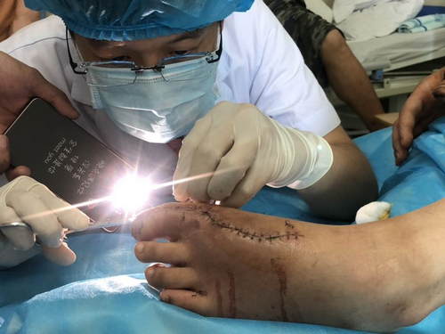 医生取下脚趾进行移植