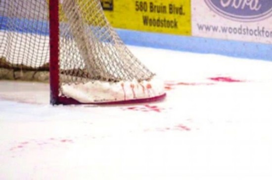 冰球选手被冰刀击中缝针案例_恐怖!曲棍球手被球击中失明 切开脑袋手术满头刀疤_冰球比赛危险事件