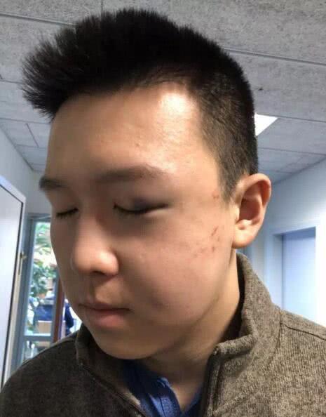 恐怖!曲棍球手被球击中失明 切开脑袋手术满头刀疤_冰球比赛危险事件_冰球选手被冰刀击中缝针案例