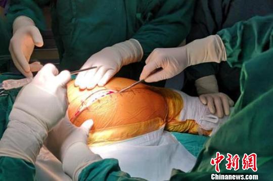 女子摇摆走路50余年系髋关节“野蛮生长”加剧病情