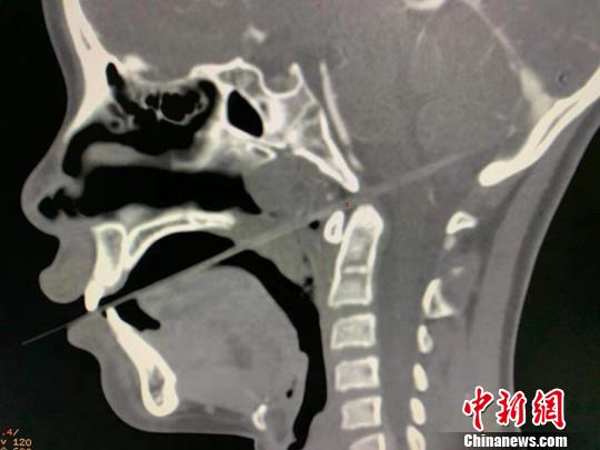 湖北一女童边吃热狗边玩蹦床竹签刺穿脑干（图）