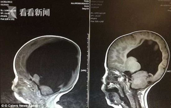左为沃尔大脑第一次扫描图 右为第二次