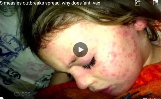 （图为当年感染麻疹的女孩 图源：路透社）