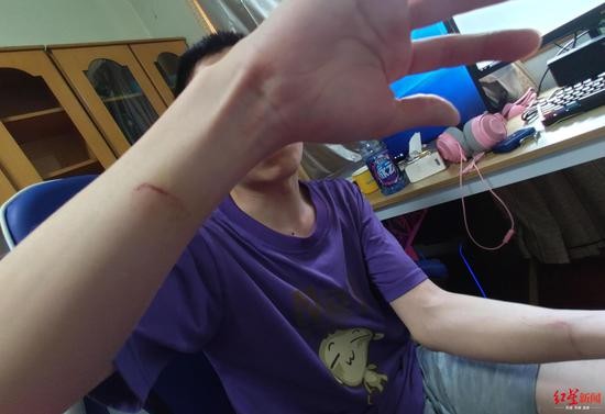 &uarr;刘飞的手臂在捉狗的时候多处受伤。