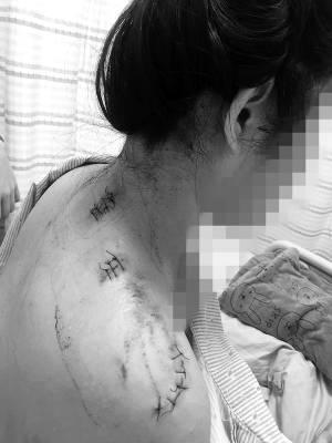 小陈身上伤痕累累。