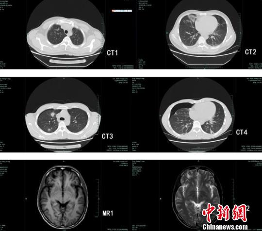 四小伙吃生蟹患肺吸虫病专家：需改变生食习惯