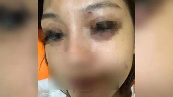 王女士被男友打至双眼肿胀淤黑