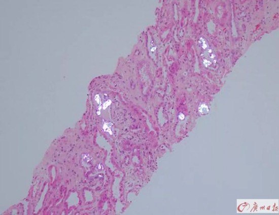 肾小管造影显示存在大量结晶沉淀物。(银白色部分)