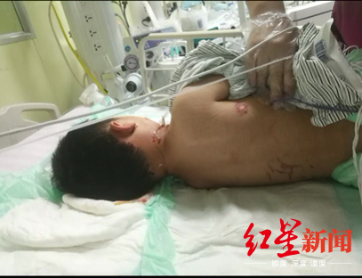 狗咬伤|5岁男童被狗咬伤 “两名狗主人”被判赔9万余元