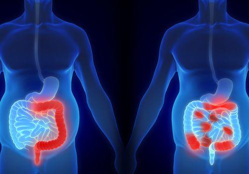  ▲医学专家指出，有些溃疡性结肠炎患者在缓解和复发之间不断受折磨。图据Verywell Health