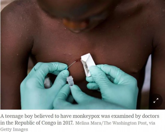 美国发现1名从尼日利亚返美的猴痘病毒病例。/《纽约时报》报道截图