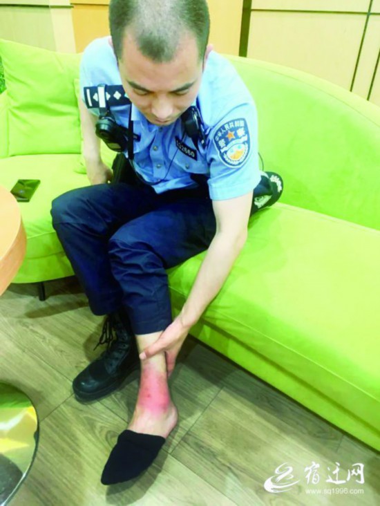 脚腕烫伤02(2144528)-20220530091024