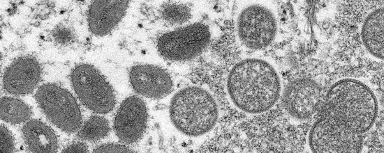 电子显微镜下的猴痘病毒。（辛苦图）
