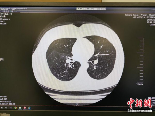 孙梅肺部ct检测情况良好 受访者供图