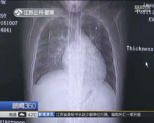 80后小伙心脏比常人大三倍 换心后重获新生