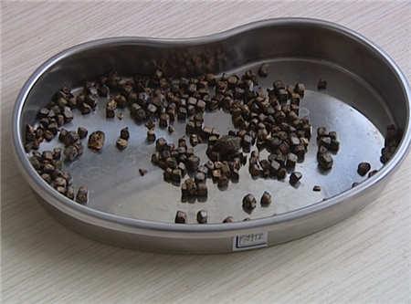 81岁老人切除胆囊 取出282颗胆结石