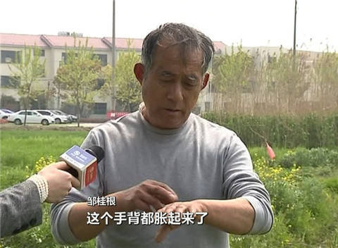 老人被蛇咬不在意 延误治疗蛇毒侵袭全身