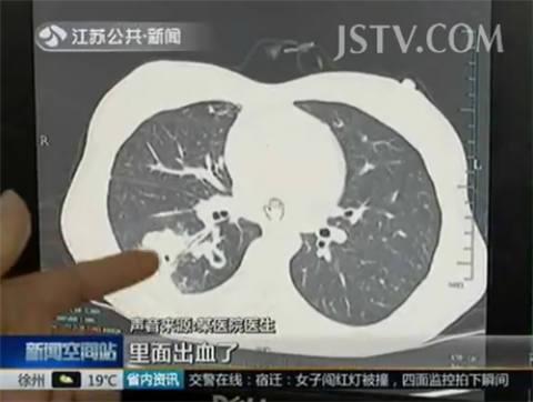 女子吃小龙虾竟咳血 寄生虫潜伏肺部