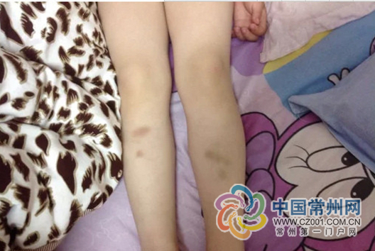 武进夏溪幼儿园被指"打孩子":家长发帖被责怪